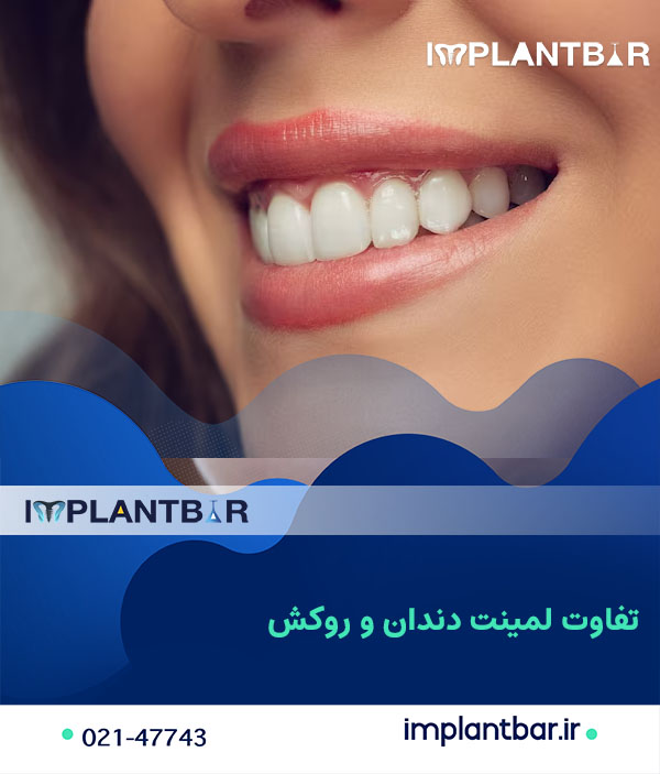dental-laminate-is-better-or-veneer1.jpg