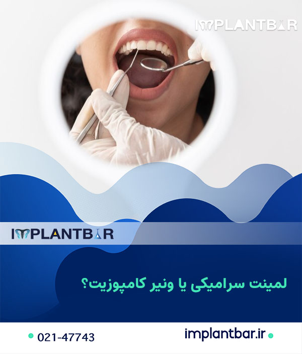 لمینت سرامیکی و ونیر کامپوزیت