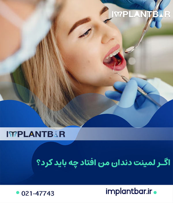 پس از افتادن لمینت دندان چه باید کرد؟