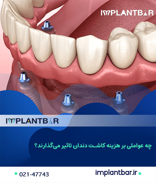 چه عواملی بر هزینه ایمپلنت دندان تاثیر می‌گذارند؟