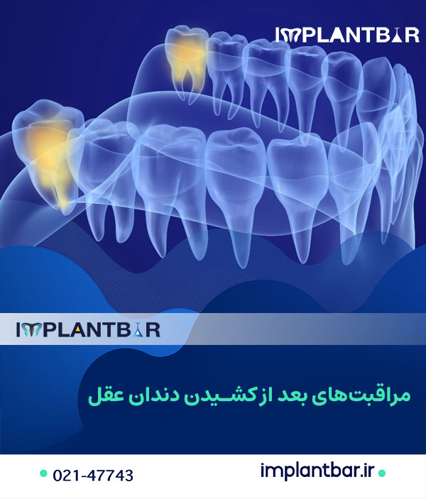 Where-is-the-wisdom-tooth1.jpg