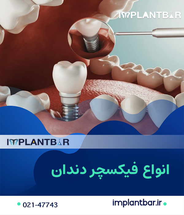 dental-fixture1.jpg