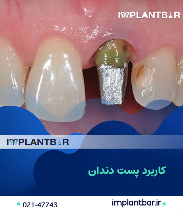 کاربرد پست دندان