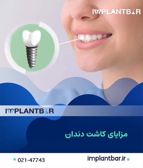 مزایای کاشت دندان: چرا ایمپلنت را انتخاب کنیم؟