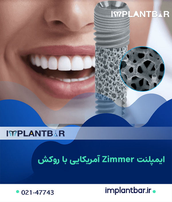 ایمپلنت Zimmer آمریکایی با روکش