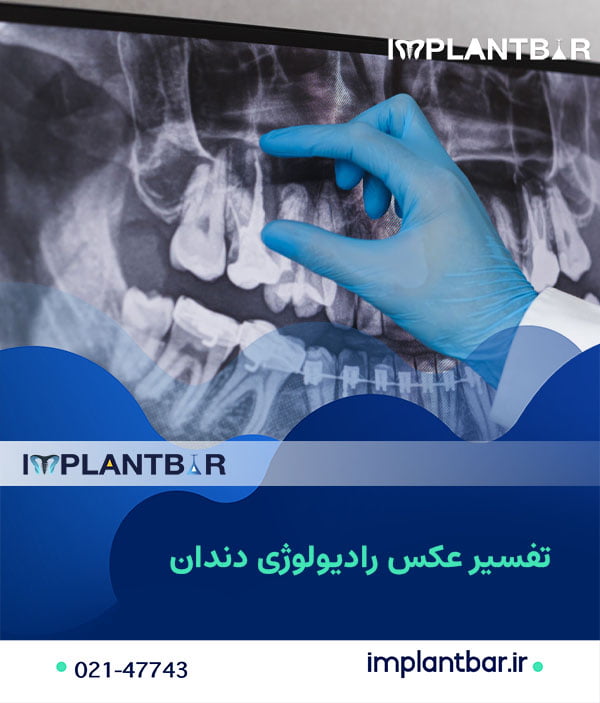 تشخیص پوسیدگی و عفونت دندان از روی عکس رادیولوژی